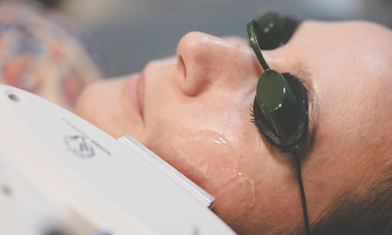 woman experiencing IPL laser treatment