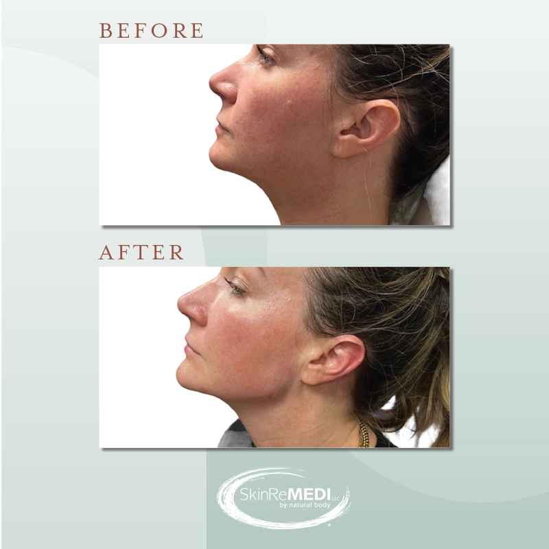 Before and After of female Juvéderm Volux® for definition and Volume™ XC in chin