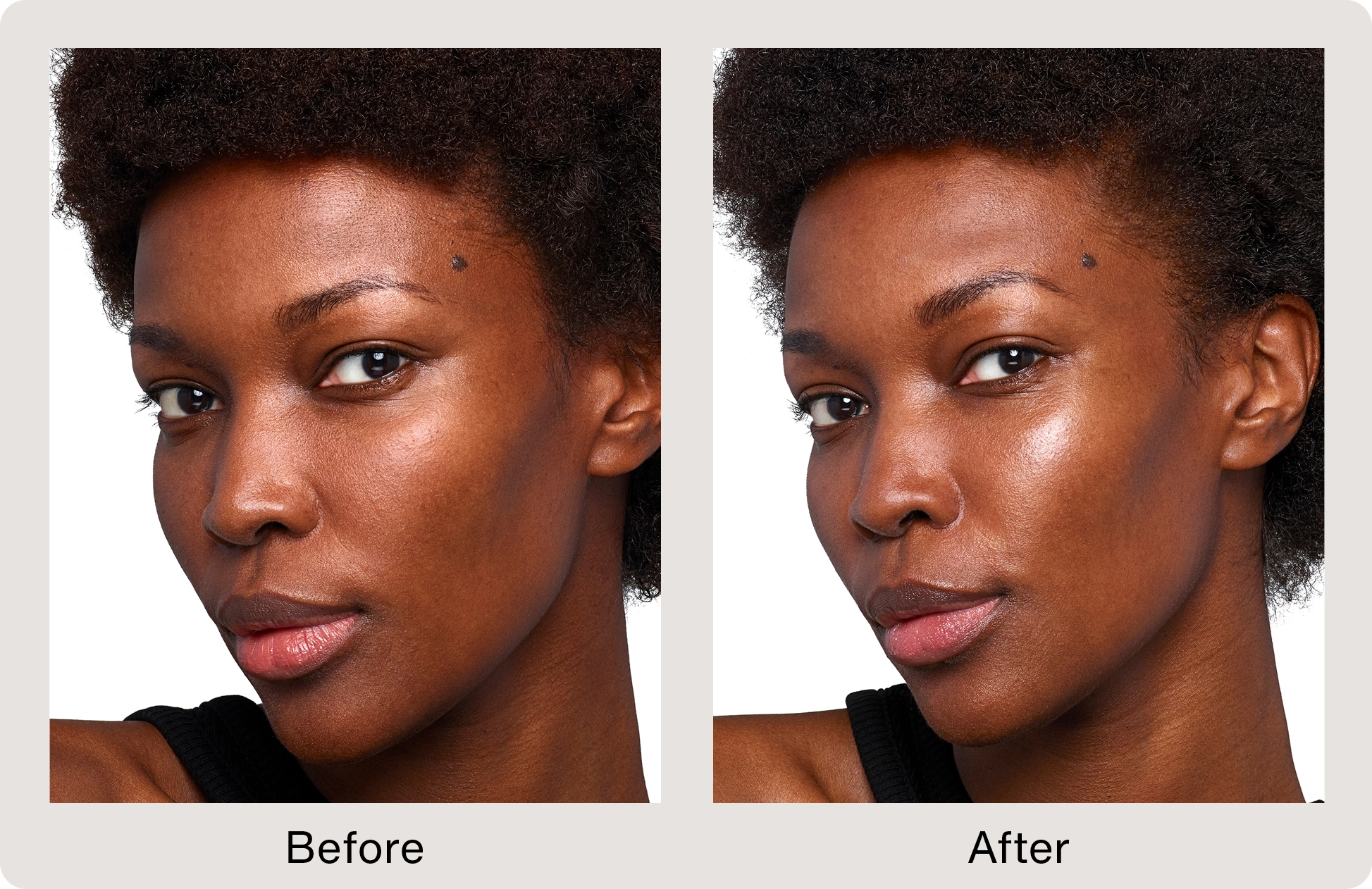 SKINVIVE™ by JUVÉDERM® Before and After of female