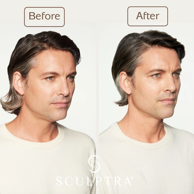 Sculptra Before and After of male