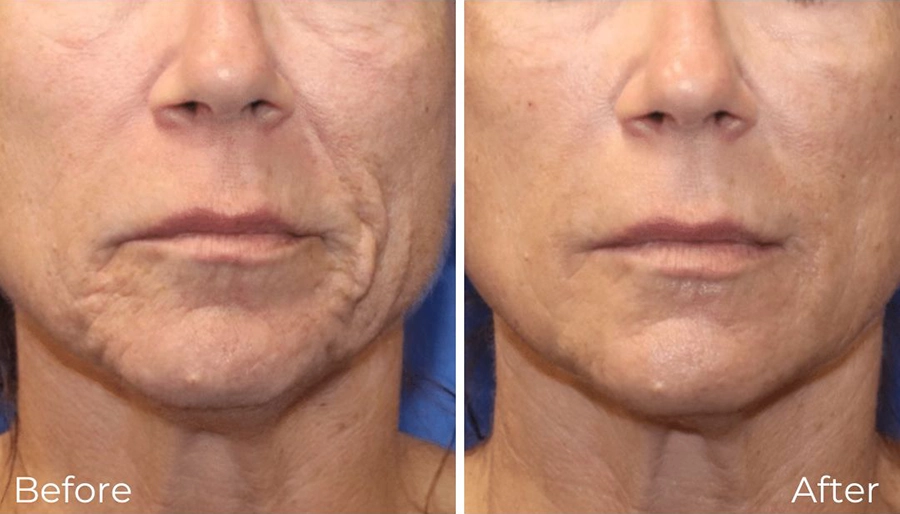 RF Microneedling