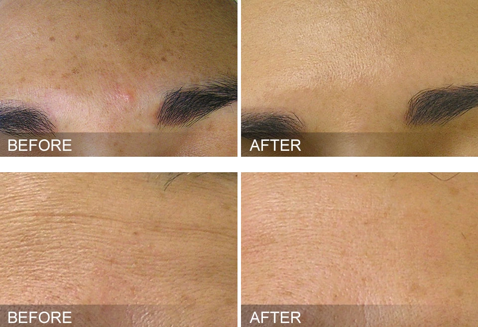 HydraFacial Treatment before and after brown spots