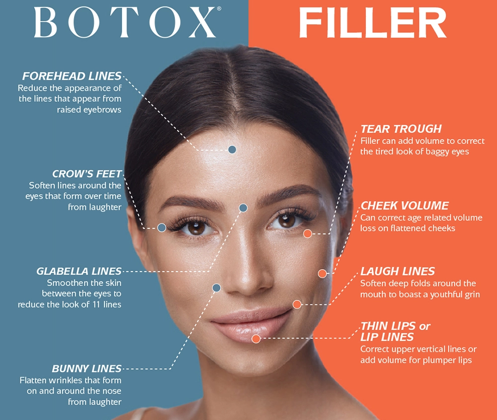 Botox vs filler diagram