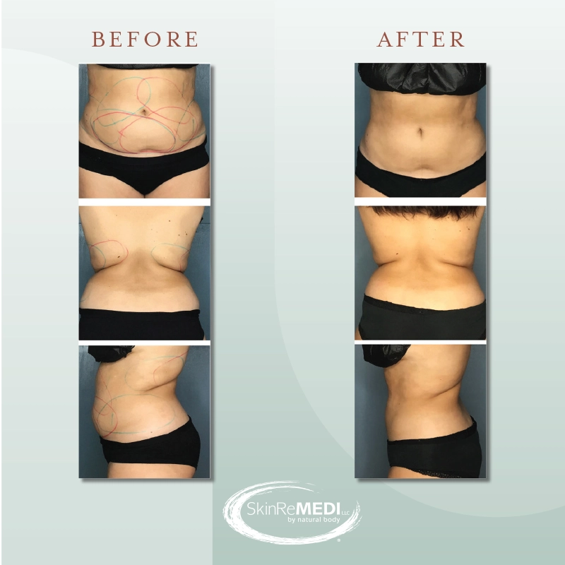 CoolSculpting® Before and After at Natural Body Spa & SkinReMEDI
