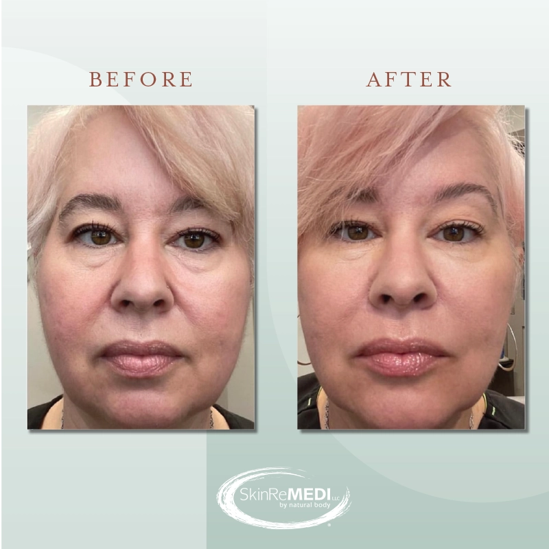 Before and After at Natural Body Spa & SkinReMEDI