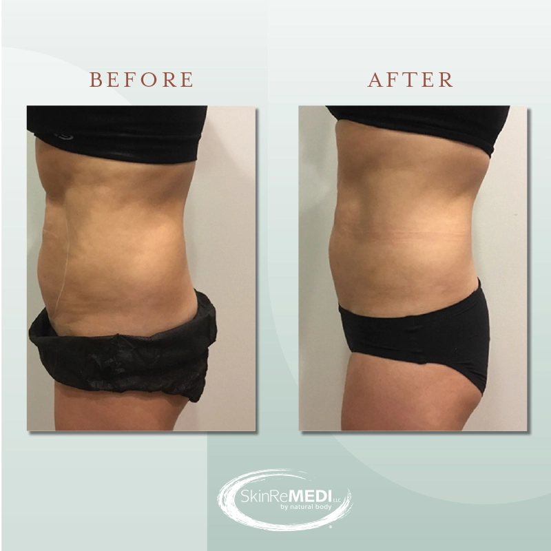 CoolSculpting® Before and After at Natural Body Spa & SkinReMEDI