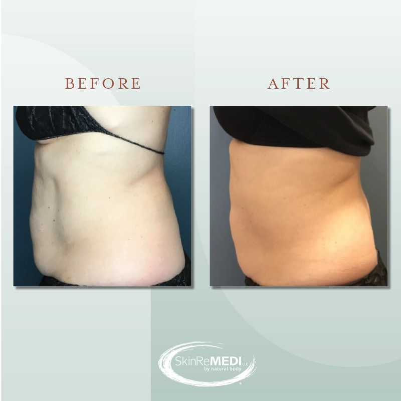 CoolSculpting® Before and After at Natural Body Spa & SkinReMEDI