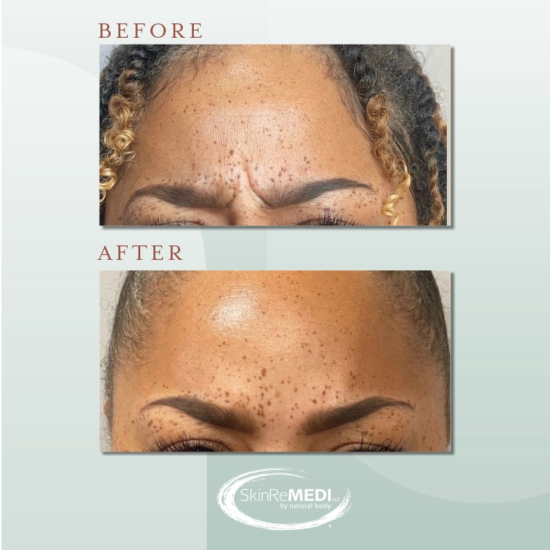 Botox + Fillers Before and After at Natural Body Spa & SkinReMEDI