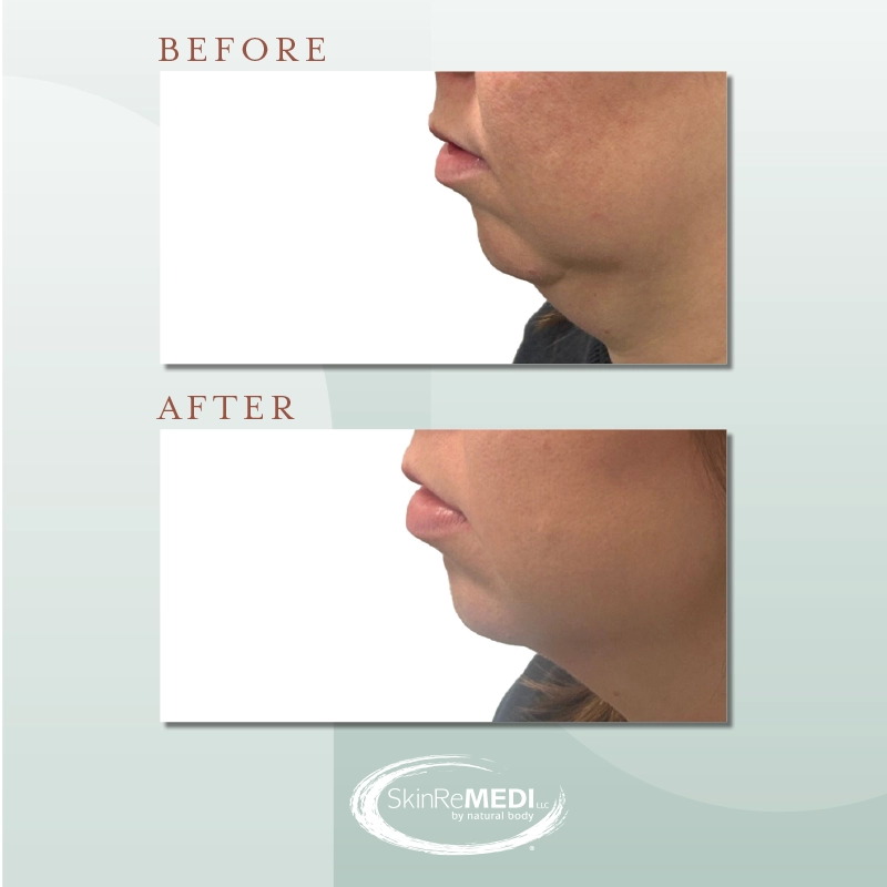 Botox + Fillers Before and After at Natural Body Spa & SkinReMEDI