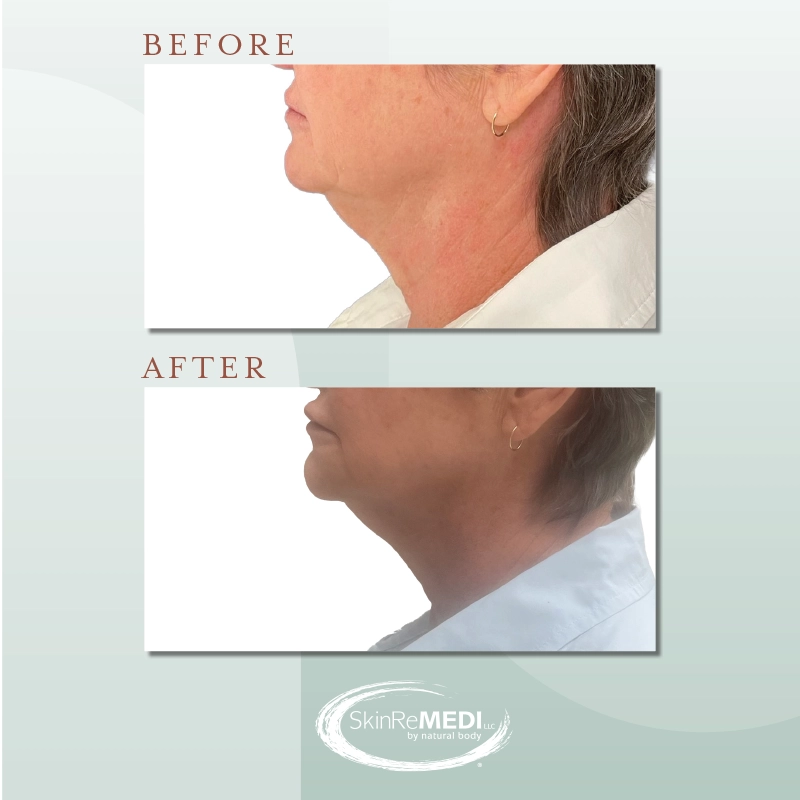Botox + Fillers Before and After at Natural Body Spa & SkinReMEDI