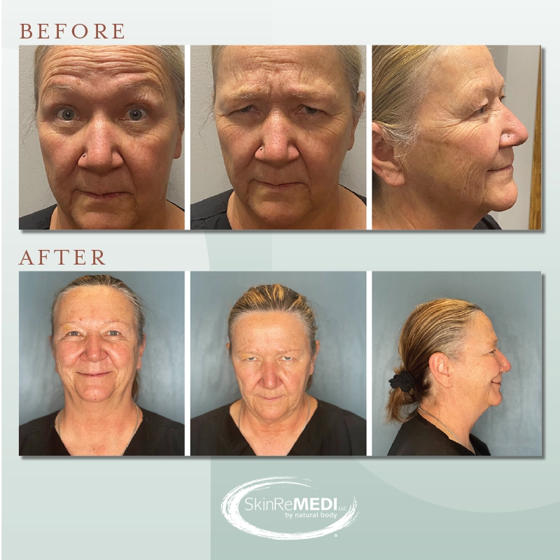 Botox + Fillers Before and After at Natural Body Spa & SkinReMEDI