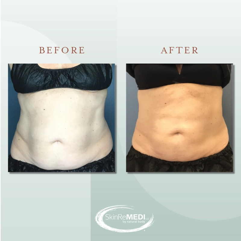 CoolSculpting® Before and After at Natural Body Spa & SkinReMEDI