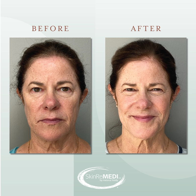 Microneedling + Filler Before and after at Natural Body Spa & SkinReMEDI Alpharetta