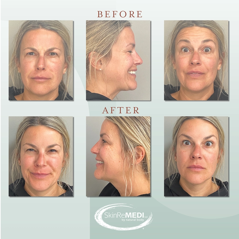 Botox Treatment  Before and after at Natural Body Spa & SkinReMEDI Alpharetta