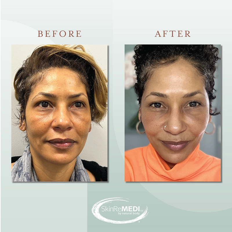 Jawline & Cheek Filler Before and after at Natural Body Spa & SkinReMEDI Alpharetta