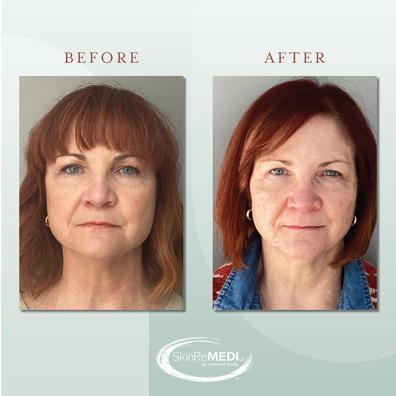 Erbium Before and after at Natural Body Spa & SkinReMEDI Alpharetta