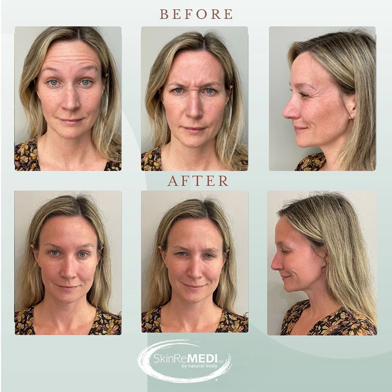 Botox Treatment  Before and after at Natural Body Spa & SkinReMEDI Brookhaven - Atlanta