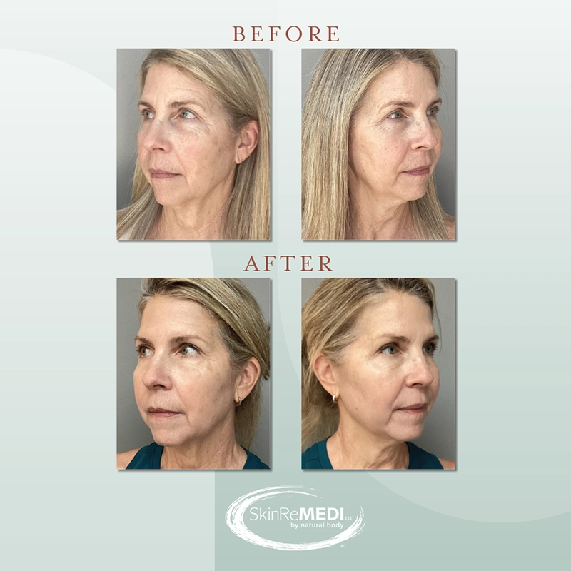 Erbium Laser Before and after at Natural Body Spa & SkinReMEDI Alpharetta