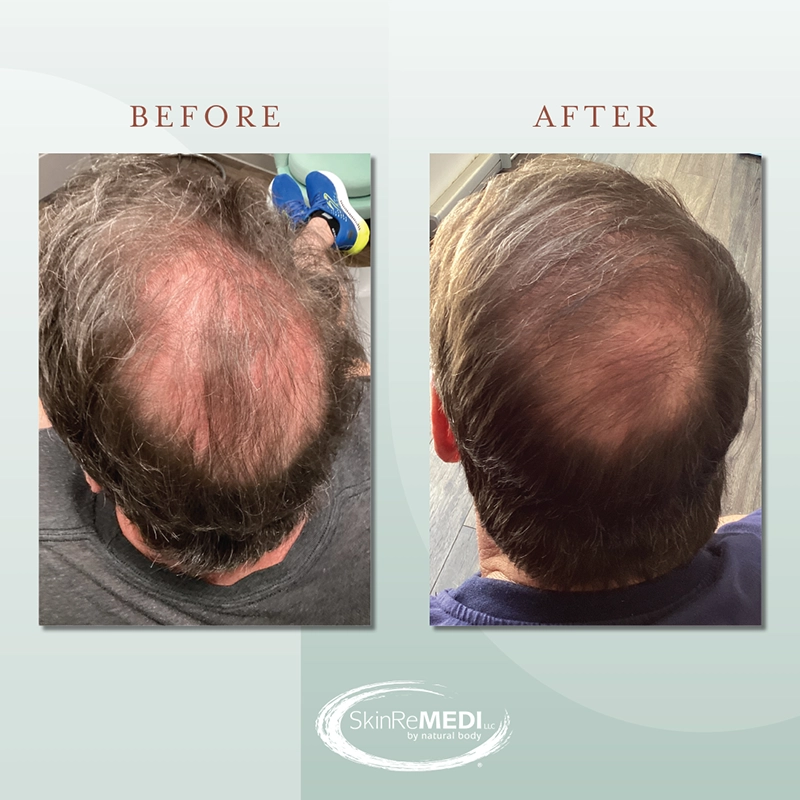 PRP Before and after at Natural Body Spa & SkinReMEDI Alpharetta