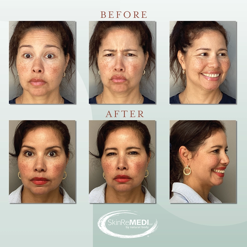 Botox Before and after at Natural Body Spa & SkinReMEDI Alpharetta