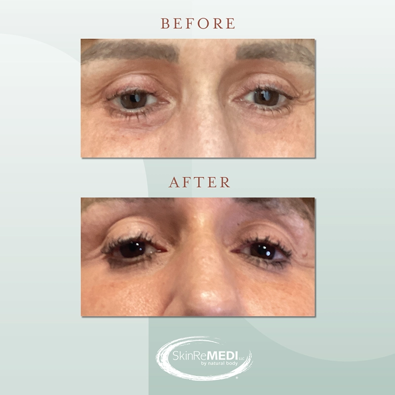 PRP Before and after at Natural Body Spa & SkinReMEDI Alpharetta