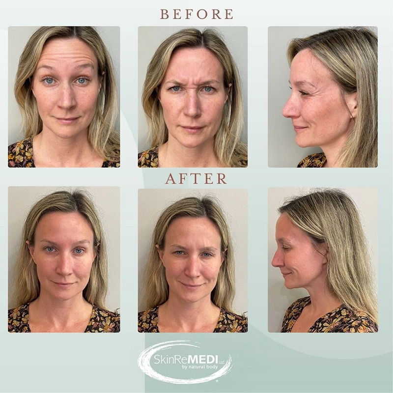 Botox Before and After by Courtney Patton, PA-C in Natural Body Spa and SkinReMEID Brookhaven