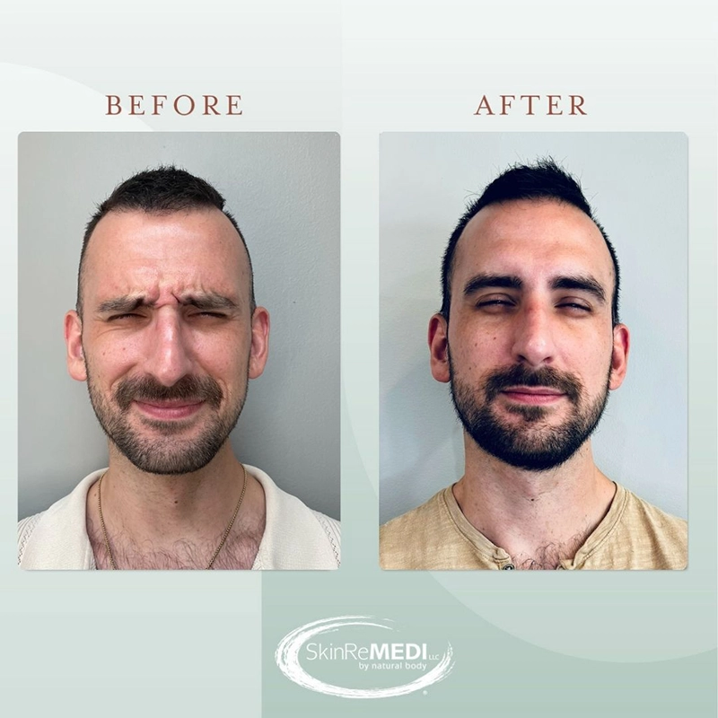 Botox Before and After by Courtney Patton, PA-C in Natural Body Spa and SkinReMEID Brookhaven