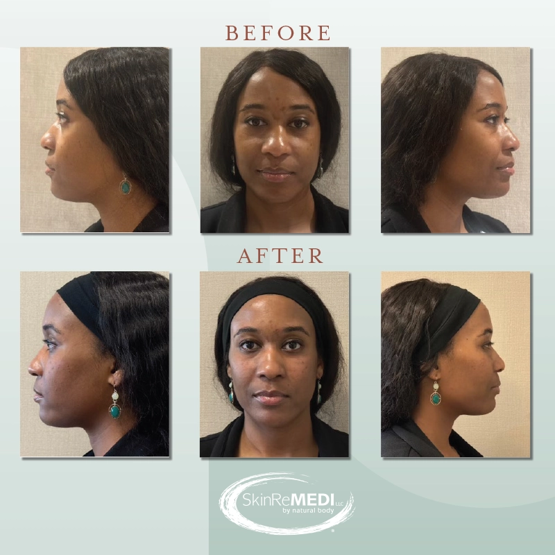 Mid Face Rejuvenation with 2 Syringes of VOLUMA® XC 
by Courtney Patton, PA-C at Natural Body Spa and SkinReMEDI