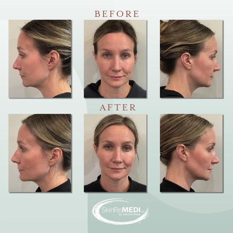 Before and after of Facial Balancing - Cheeks, Chin, and Jawline with VOLUMA® XC and VOLUX® XC
by Courtney Patton, PA-C at Natural Body Spa and SkinReMEDI